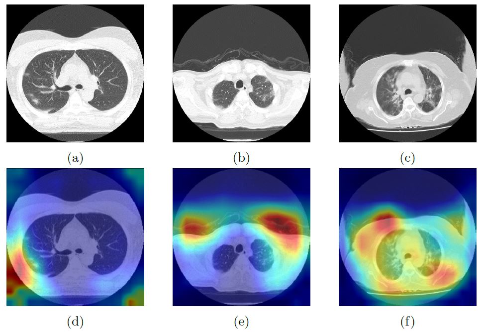 Mixup data augmentation for COVID-19 infection percentage estimation